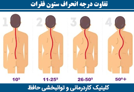 تفاوت-درجه-انحراف-ستون-فقرات
