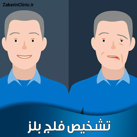 تشخیص-فلج-بلز