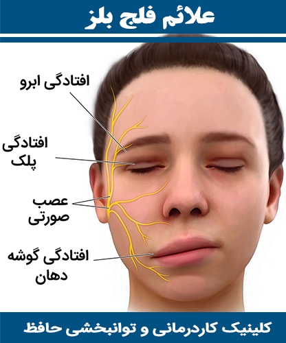علائم-فلج-بلز