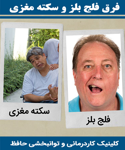 فرق-فلج-بلز-و-سکته-مغزی