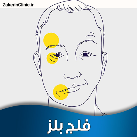 فلج-بلز