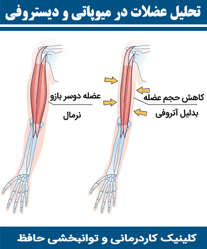 تحلیل-عضلات-در-میوپاتی-و-دیستروفی