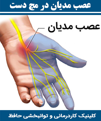 عصب-مدیان-در-مچ-دست