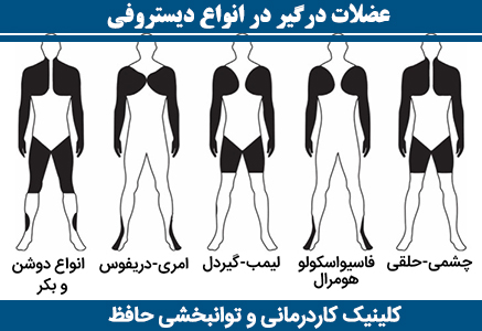 عضلات-درگیر-در-انواع-دیستروفی