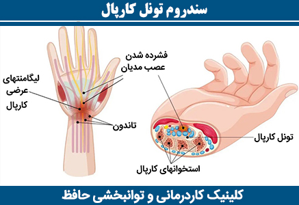 سندروم-تونل-کارپال