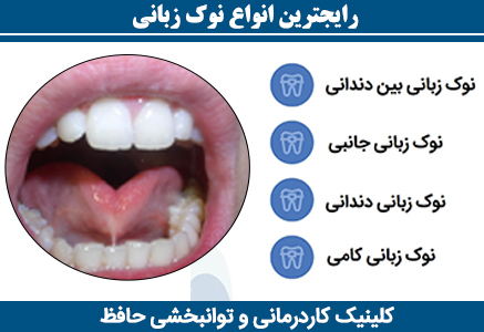 رایجترین-انواع-نوک-زبانی